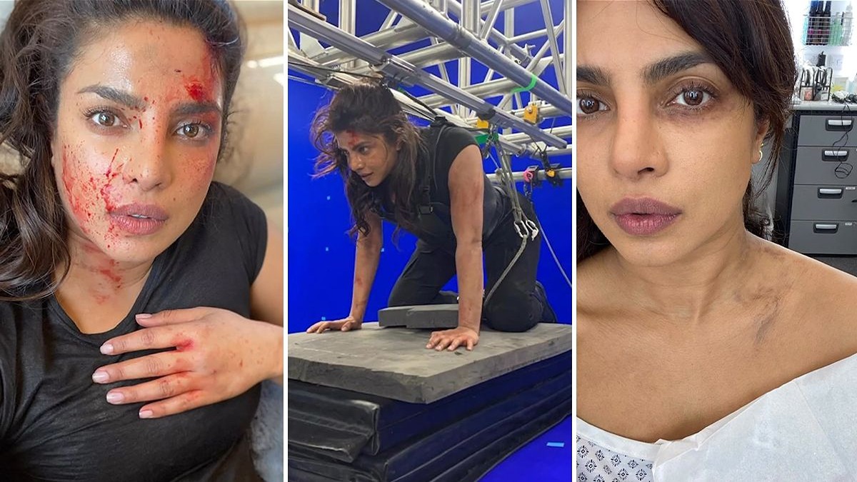 “She is Pushing Too Hard” Priyanka Chopra’s New Photos With Bruises Have Concerned Her Fans