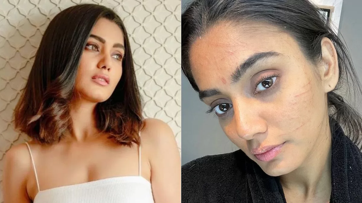 Sana Makbul Reveals About Battling F4 Autoimmune Hepatitis, ‘Lot Of Hairfall, Lost Work’