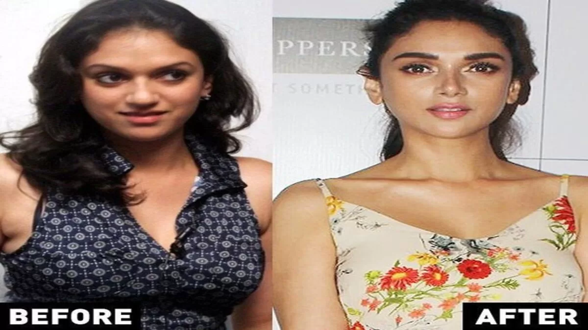 Aditi Rao Hydari’s Before-After Pictures Takes Internet By Storm, ‘Her Surgeon Is Literal God’